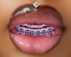 PURP braces