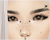 freckles