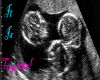2M,1F,triplet ultrasound