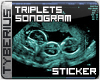 triplets sonogram