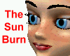 Sunburn W/Freckles