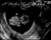 1 Month Ultrasound