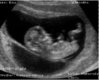 RaspberriDiva Ultrasoun