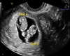 8 Weeks Twins Ultrasound