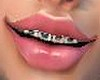 My Braces