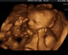 Ultrasound Couple Pose