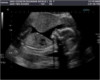 ultrasound frame
