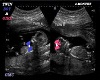 GMC Twin Ultrasound 4 M