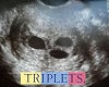 Triplets sonogram 6 week