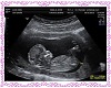 Single baby ultrasound