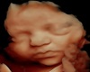 3D ULTRASOUND