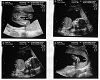 Ultrasound girl 3 months