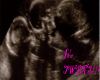 Female Twins Ultrasound