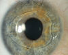 stone eye