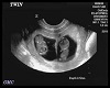 GMC Ultrasound 2 Months