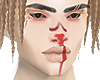 Hemorrage