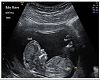 Mateo Ultrasound Pic